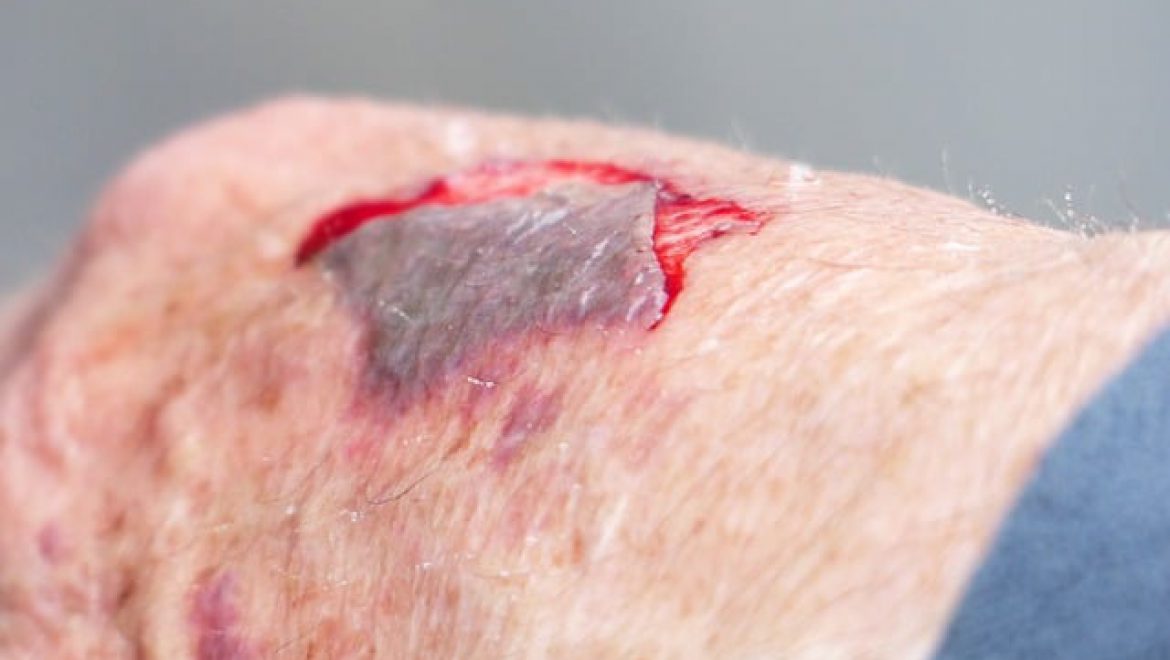 כריות לפצעי לחץ – מדוע חשוב להשתמש בהן?