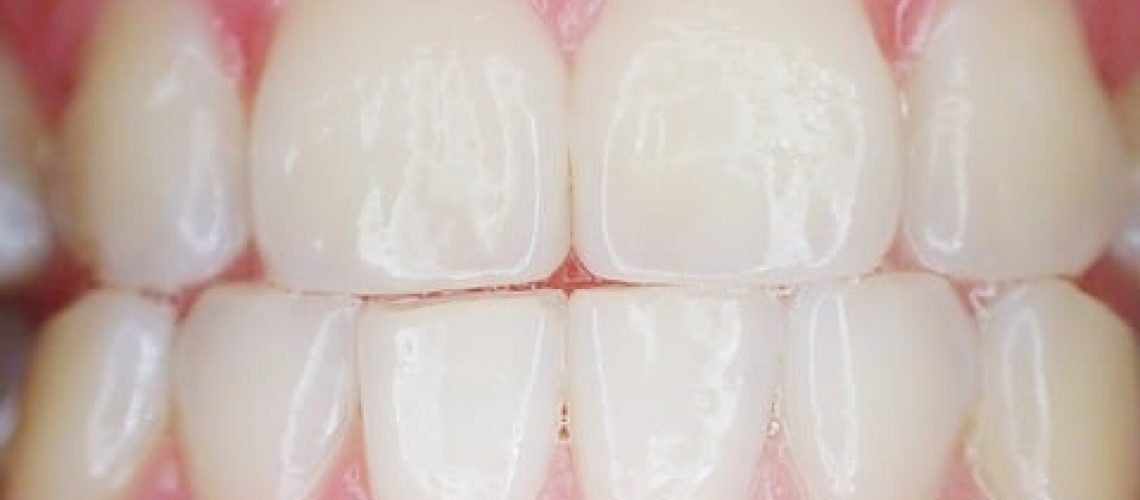 דלקות חניכיים